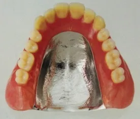 コバルトクロム金属床